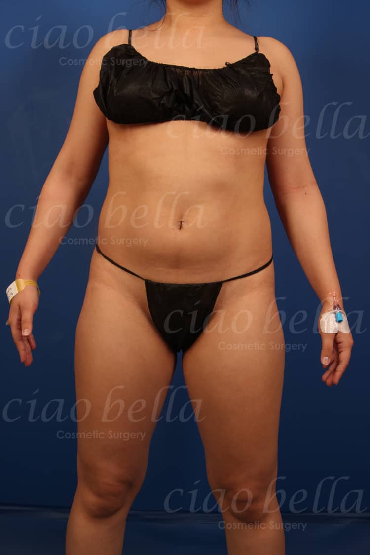 liposuction bodysculpting case#841