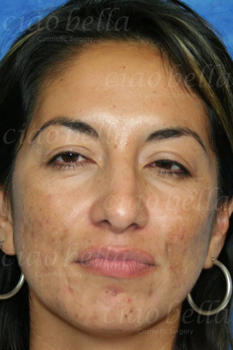 Facial Rejuvenation Case: 2257