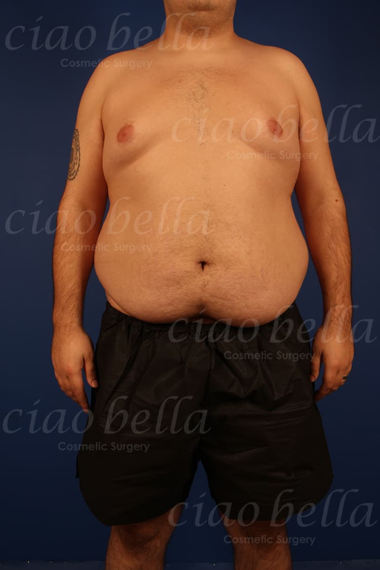 Male Liposuction Case#3333