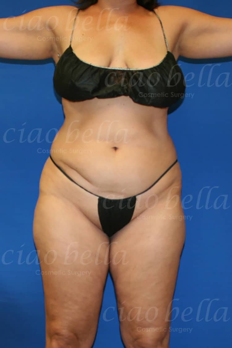 Liposuction Bodysculpting Case#243