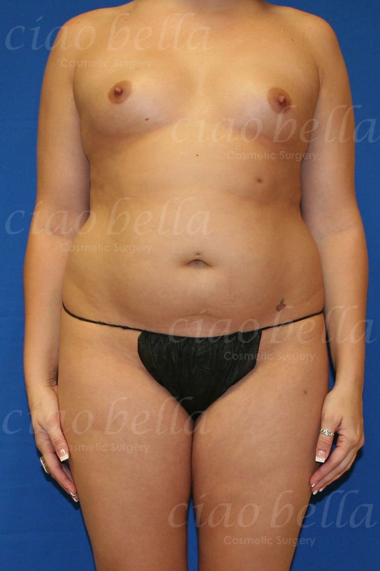 liposuction bodysculpting Case#302