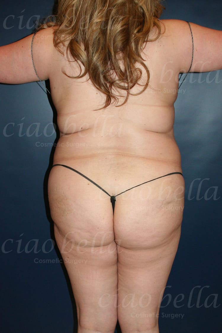 Liposuction Bodysculpting Case#320