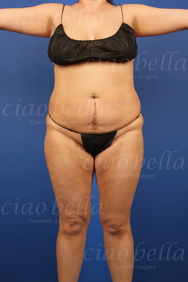 liposuction bodysculpting case#148