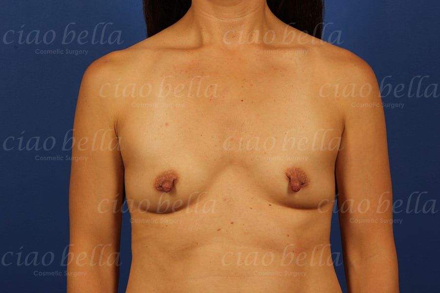 Breast Augmentation Case#408