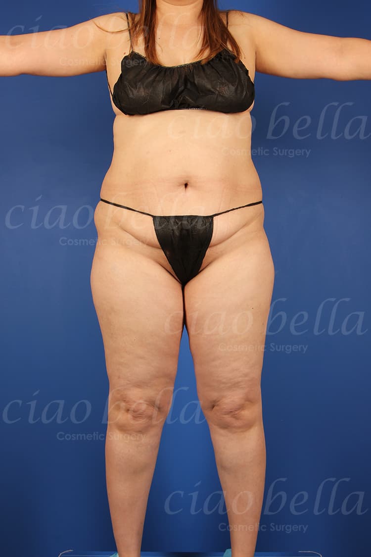 liposuction bodysculpting case#165
