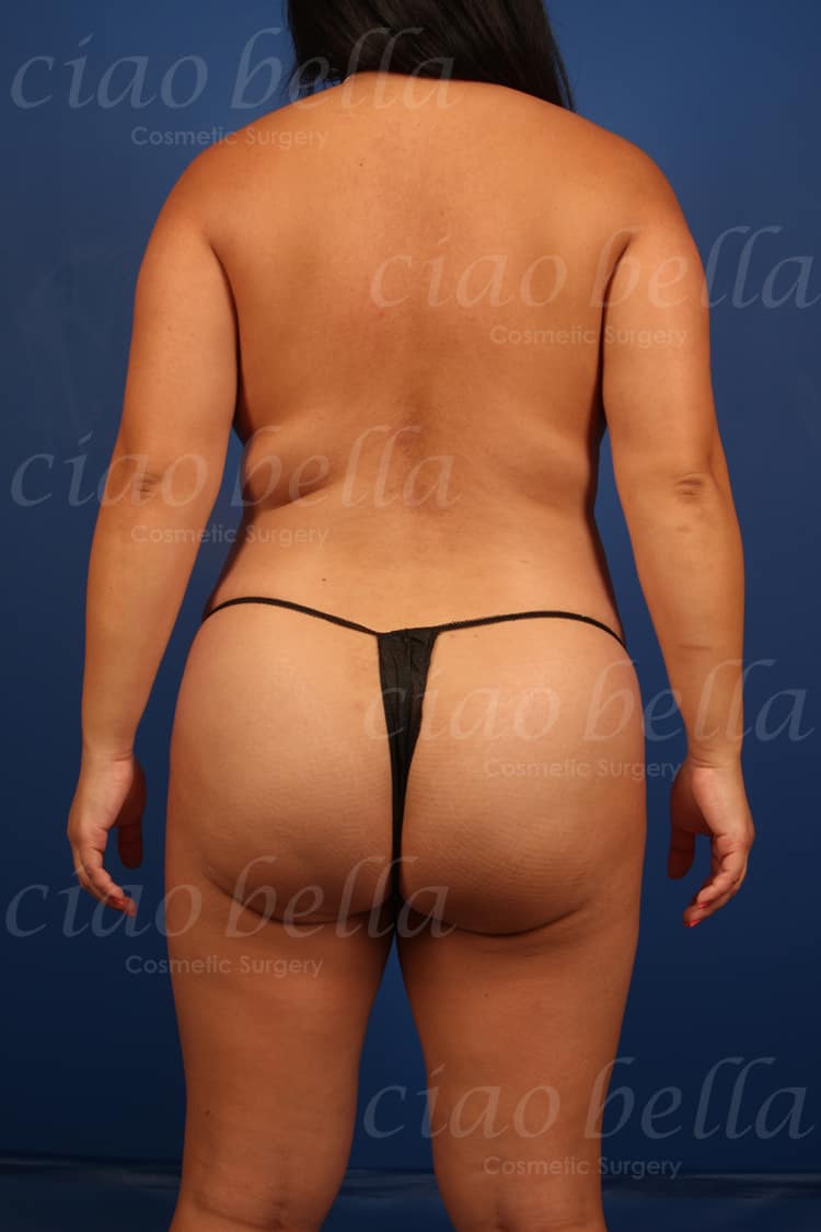 Brazilian Butt Lift Case # 6049