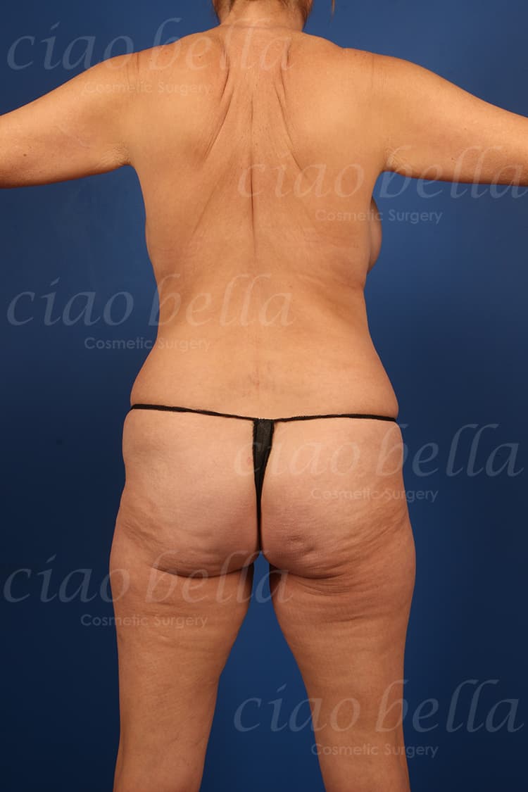 Brazilian Butt Lift Case # 4811
