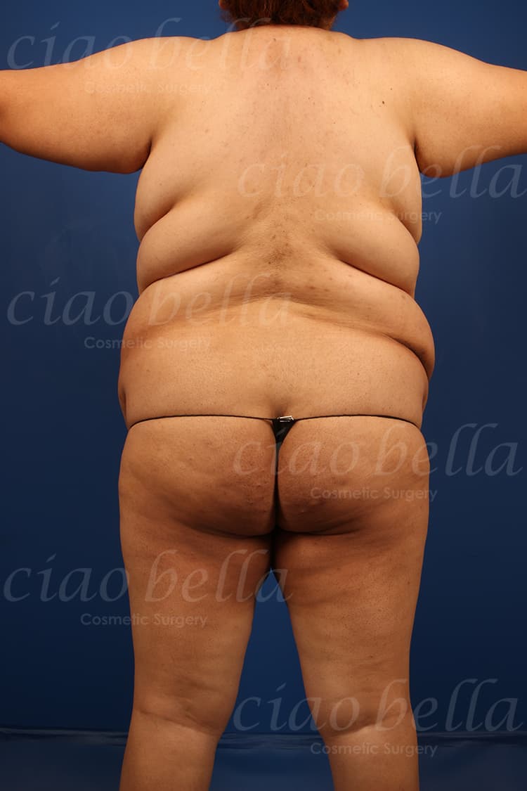 Brazilian Butt Lift Case # 5007