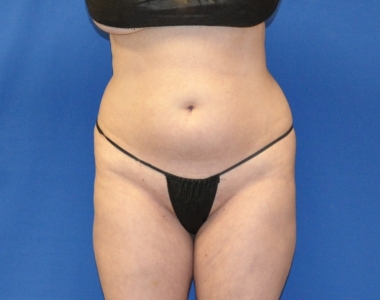 liposuction bodysculpting case#140 liposuction bodysculpting case#140