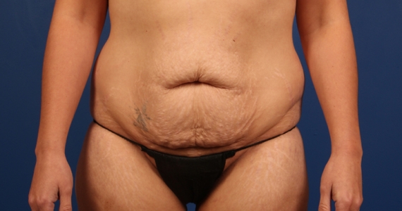 Mommy Makeover Case#1247 Mommy Makeover Case#1247