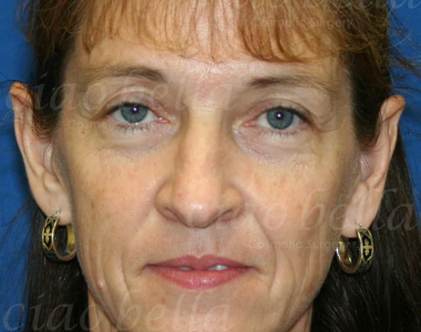 Facial Rejuvenation Case: 2287 Facial Rejuvenation Case: 2287