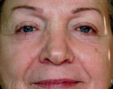 Facial Rejuvenation Case: 2284