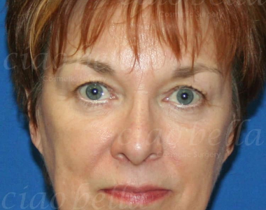 Facial Rejuvenation Case: 2271