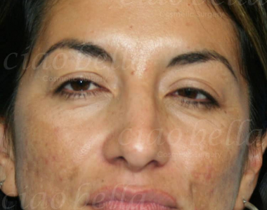 Facial Rejuvenation Case: 2257