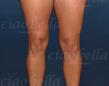 Legs Liposuction Case: 2457