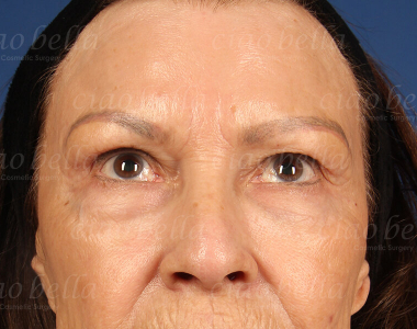 Blepharoplasty Case: 4020 Blepharoplasty Case: 4020