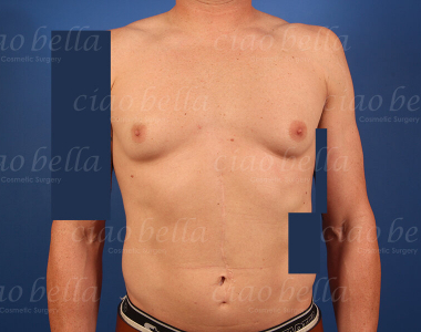 Gynecomastia Case # 6199 Gynecomastia Case # 6199