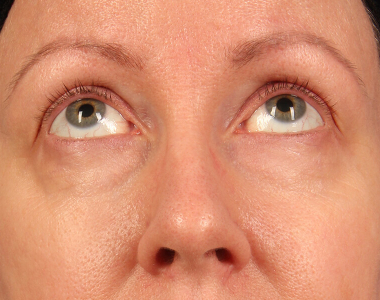 Blepharoplasty Case: 3262