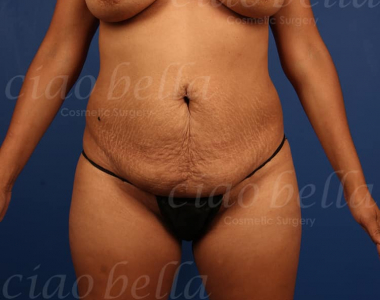 Tummy Tuck Case # 6901 Tummy Tuck Case # 6901