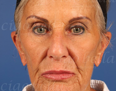 Facelift Case: 4889 Facelift Case: 4889