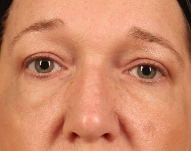 Blepharoplasty Case: 3073