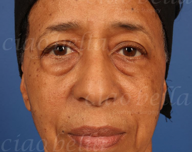 Facelift Case # 5431 Facelift Case # 5431
