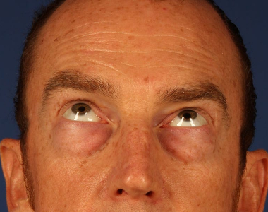 Blepharoplasty Case: 2138