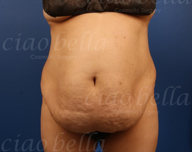 Non-Surgical Nose Job Case # 4142 Non-Surgical Nose Job Case # 4142