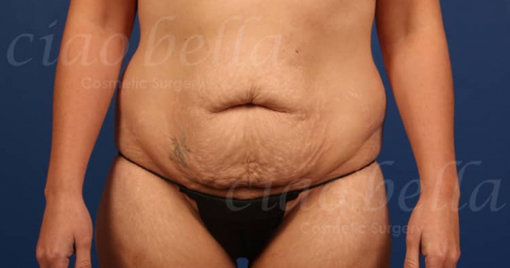 Mommy Makeover Case#1247 Mommy Makeover Case#1247