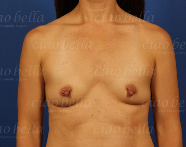 Breast Augmentation Case#408