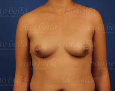 Breast Augmentation Case#480
