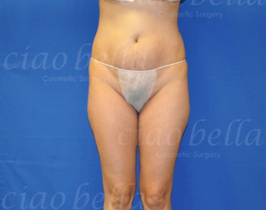 liposuction bodysculpting case#179