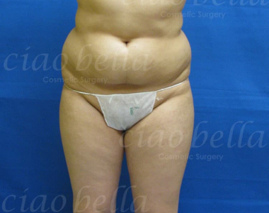 Liposuction Bodysculpting case#1009 Liposuction Bodysculpting case#1009