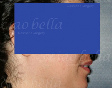 Neck Liposuction Case: 1354