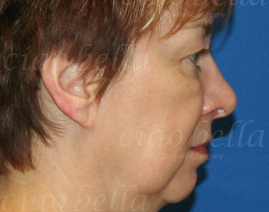 Neck Liposuction Case: 2355 Neck Liposuction Case: 2355